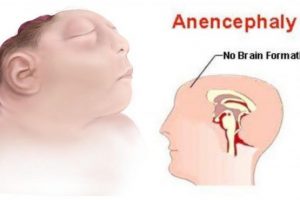 Pre-natal test for Anencephaly