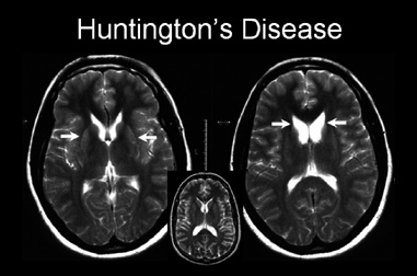Huntington's disease 