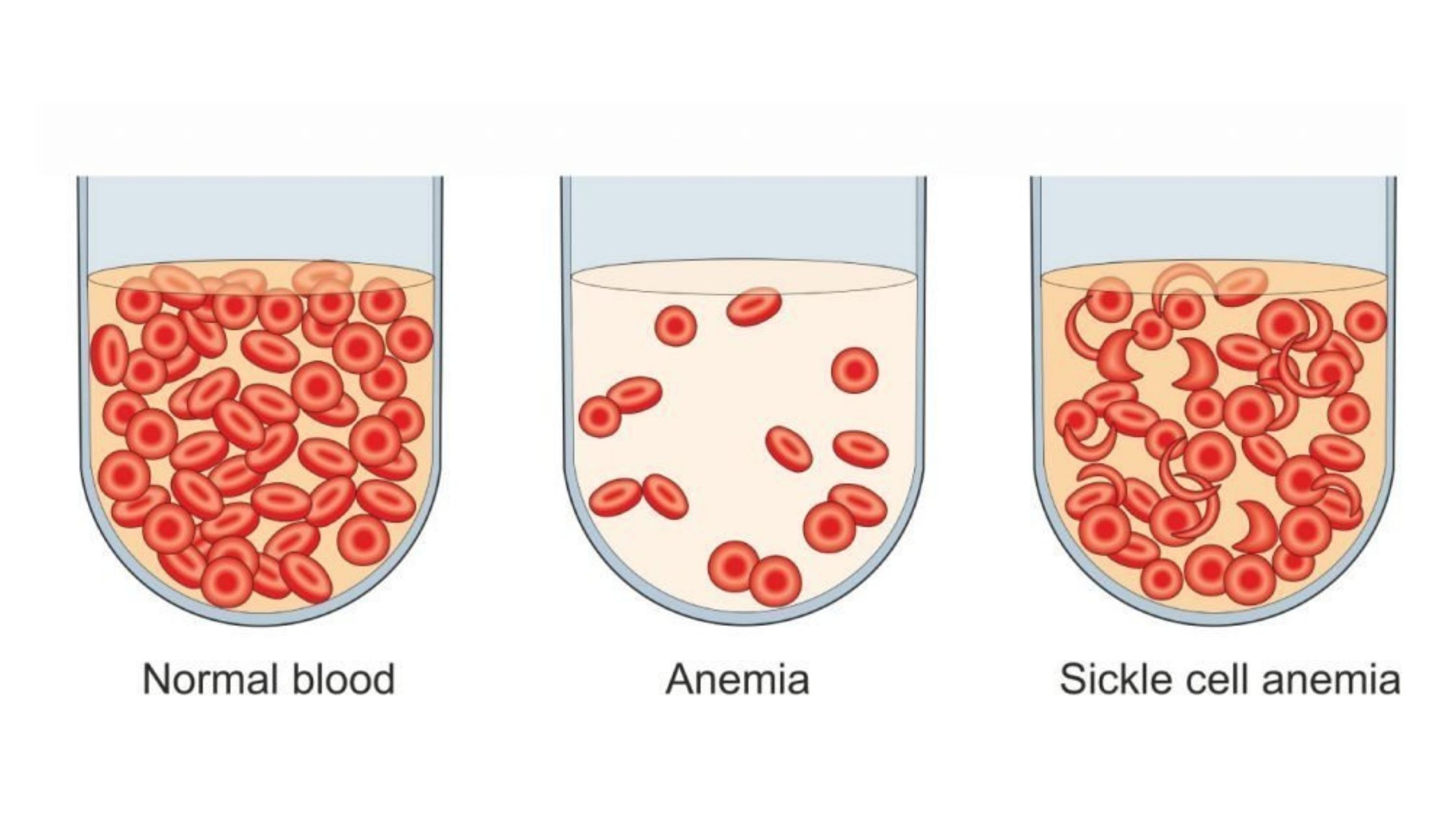 sickle cell anemia.
