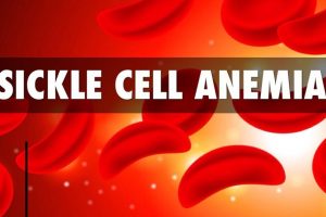 Things that you need to know about sickle cell anemia.